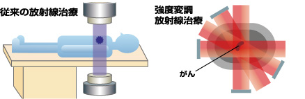 画像：放射線治療