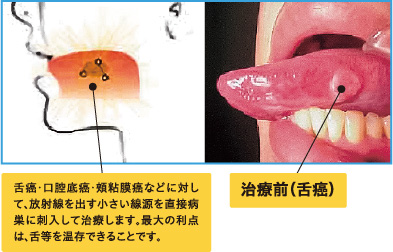 画像：密封小線源放射線治療