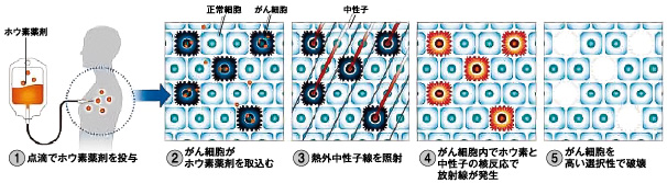 画像：ホウ素中性子捕捉療法